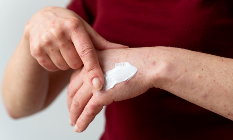 13 Tips untuk Mengelola Flare Dermatitis Atopik